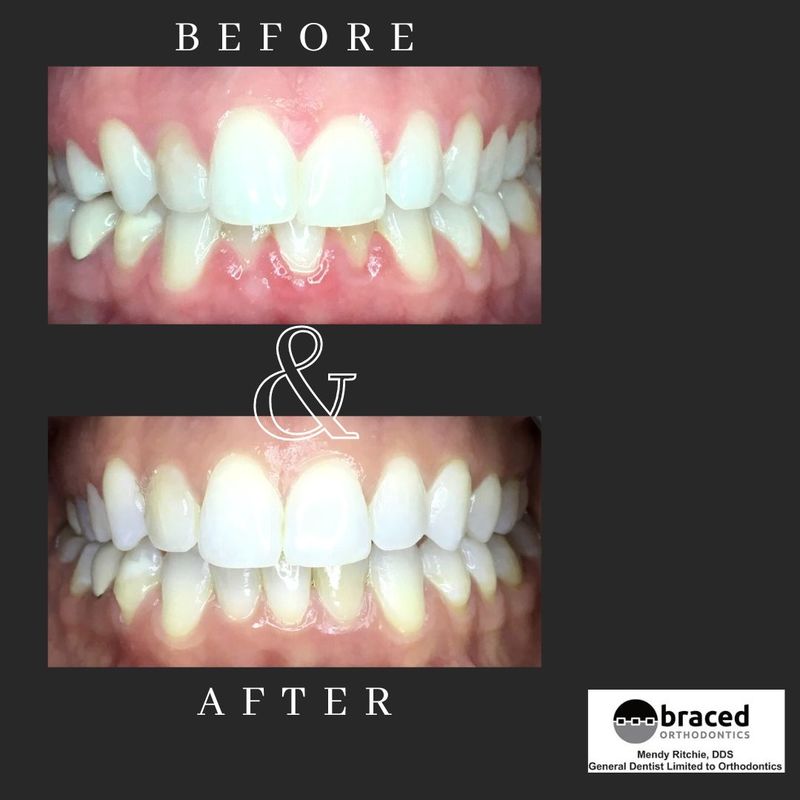 before and after braces in Marble Falls, TX