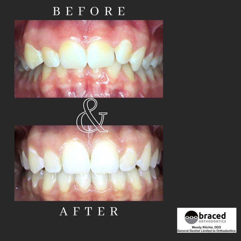 before and after braces in Marble Falls, TX