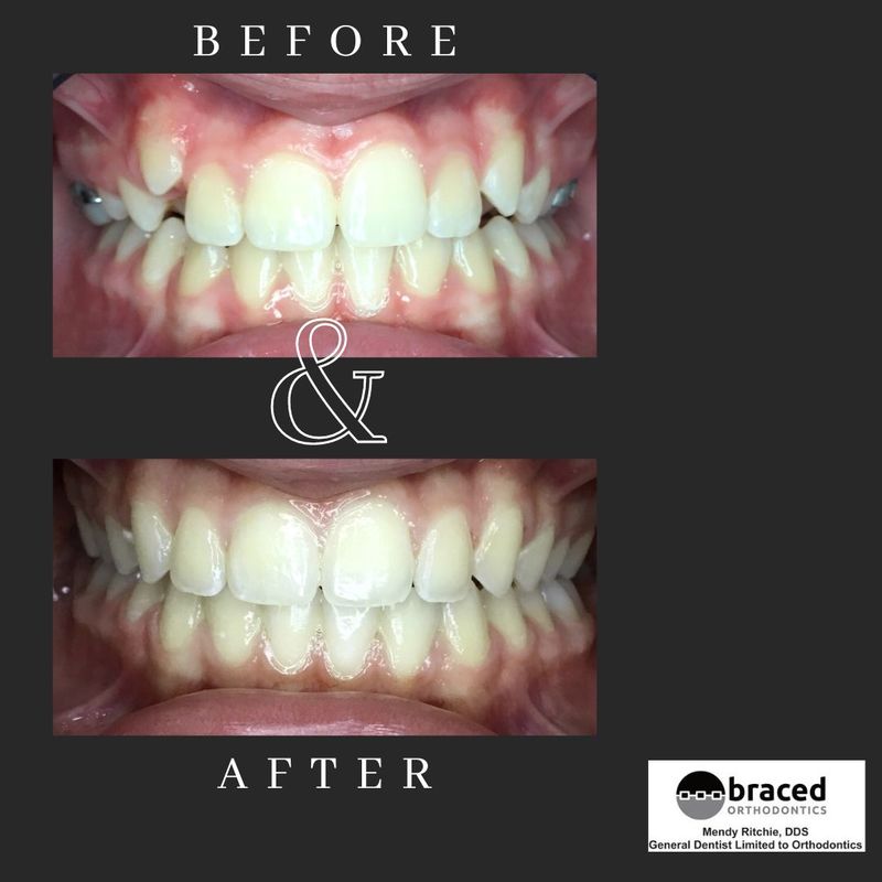 before and after braces in Marble Falls, TX