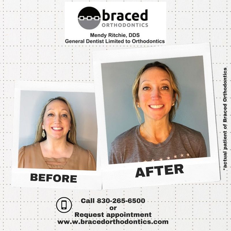 before and after braces in Marble Falls, TX
