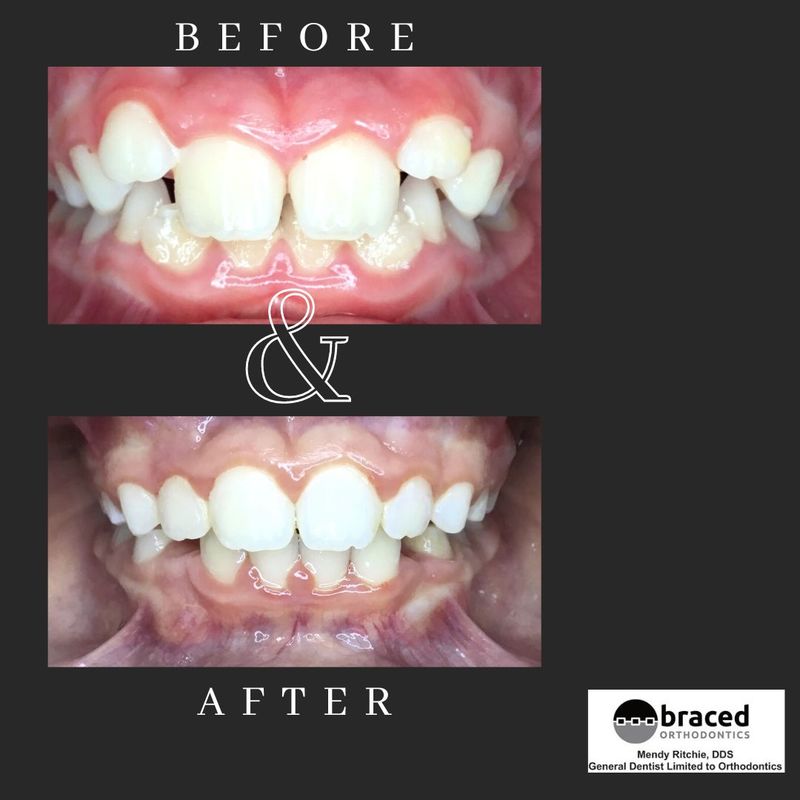 before and after braces in Marble Falls, TX