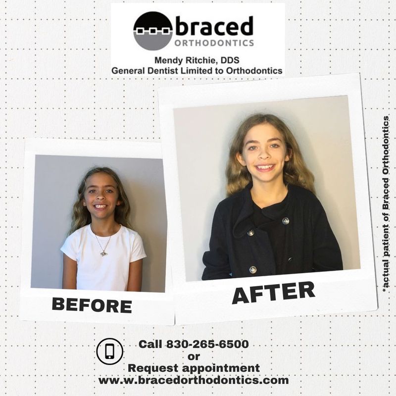 before and after braces in Marble Falls, TX