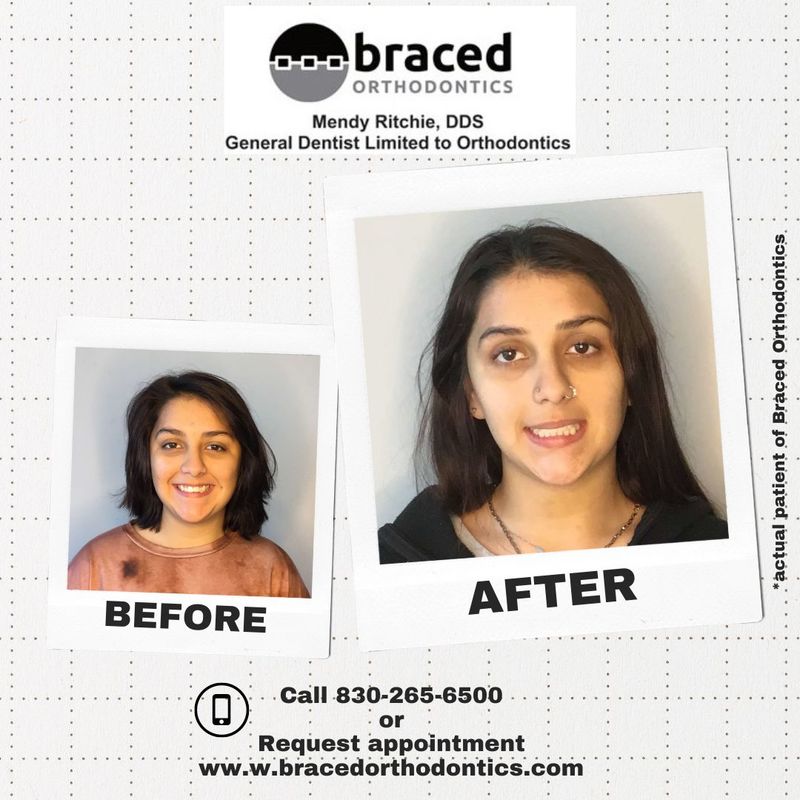 before and after braces in Marble Falls, TX
