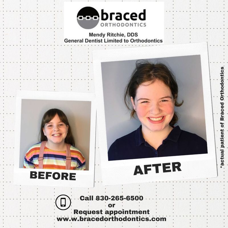 before and after braces in Marble Falls, TX