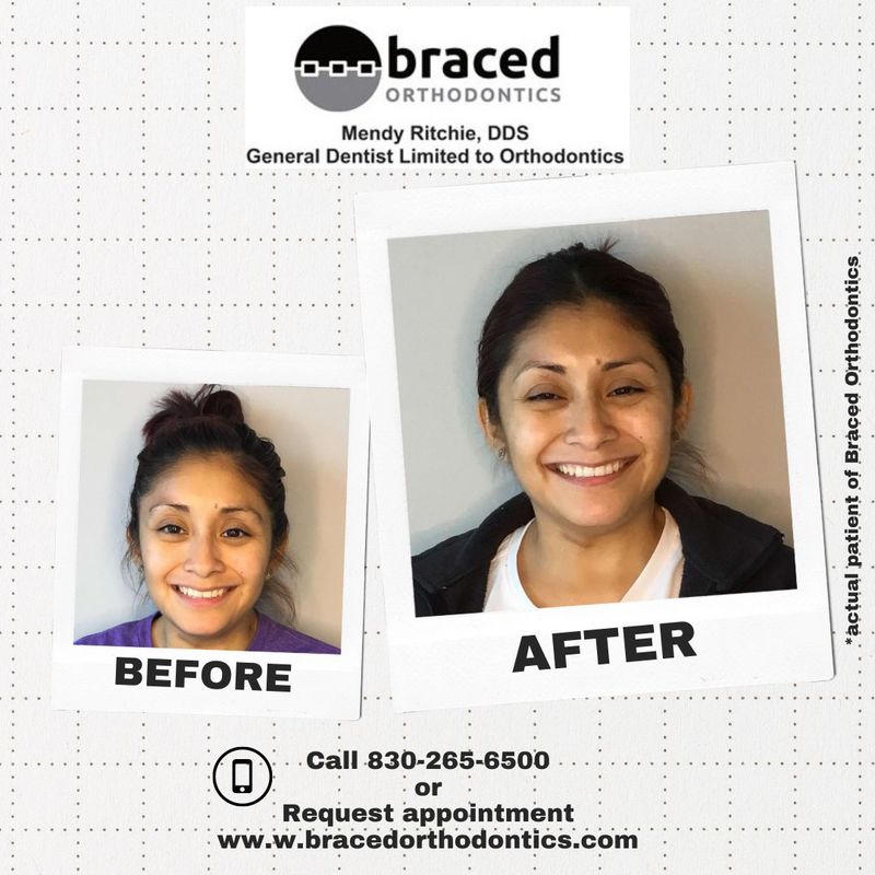 before and after braces in Marble Falls, TX
