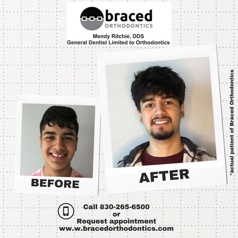 before and after braces in Marble Falls, TX