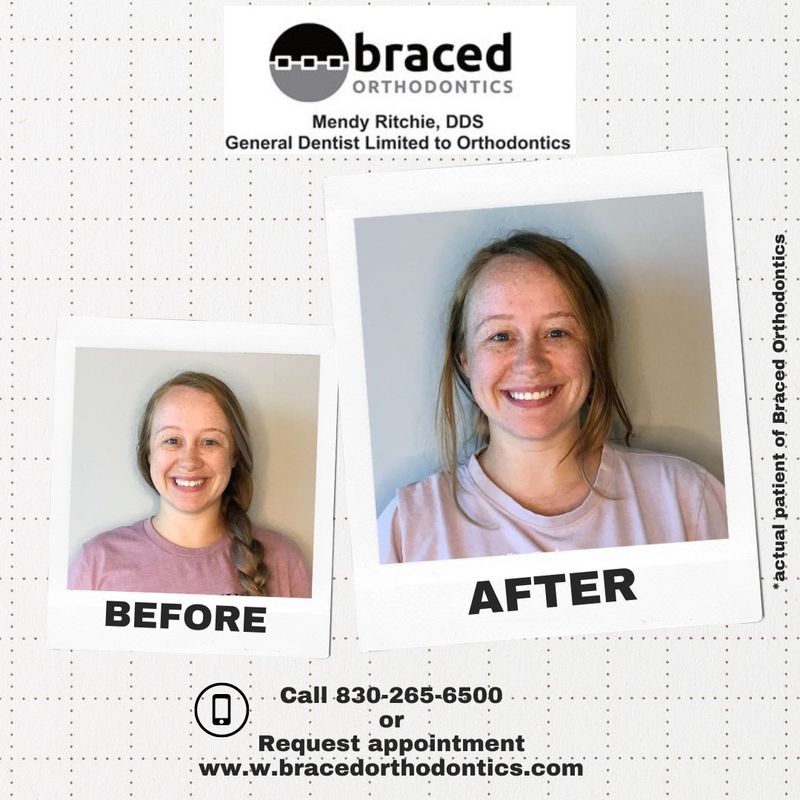 before and after braces in Marble Falls, TX