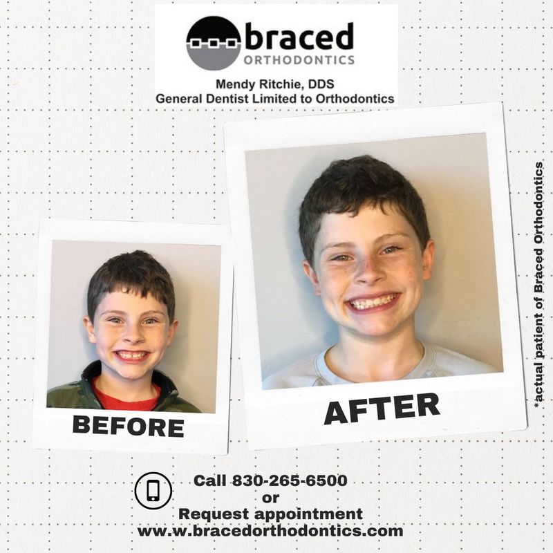 before and after braces in Marble Falls, TX