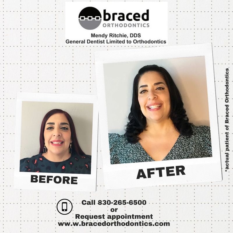 before and after braces in Marble Falls, TX