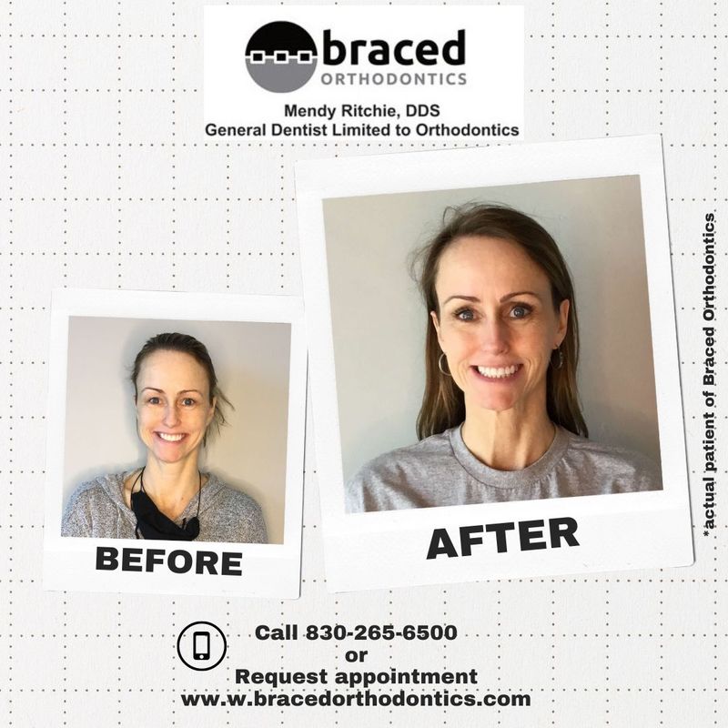 before and after braces in Marble Falls, TX