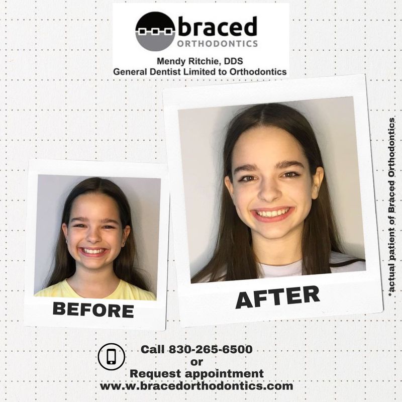 before and after braces in Marble Falls, TX