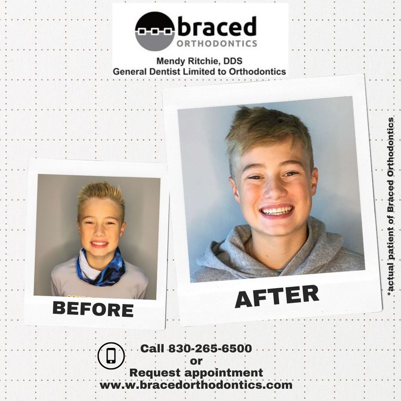 before and after braces in Marble Falls, TX
