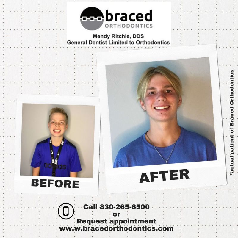 before and after braces in Marble Falls, TX