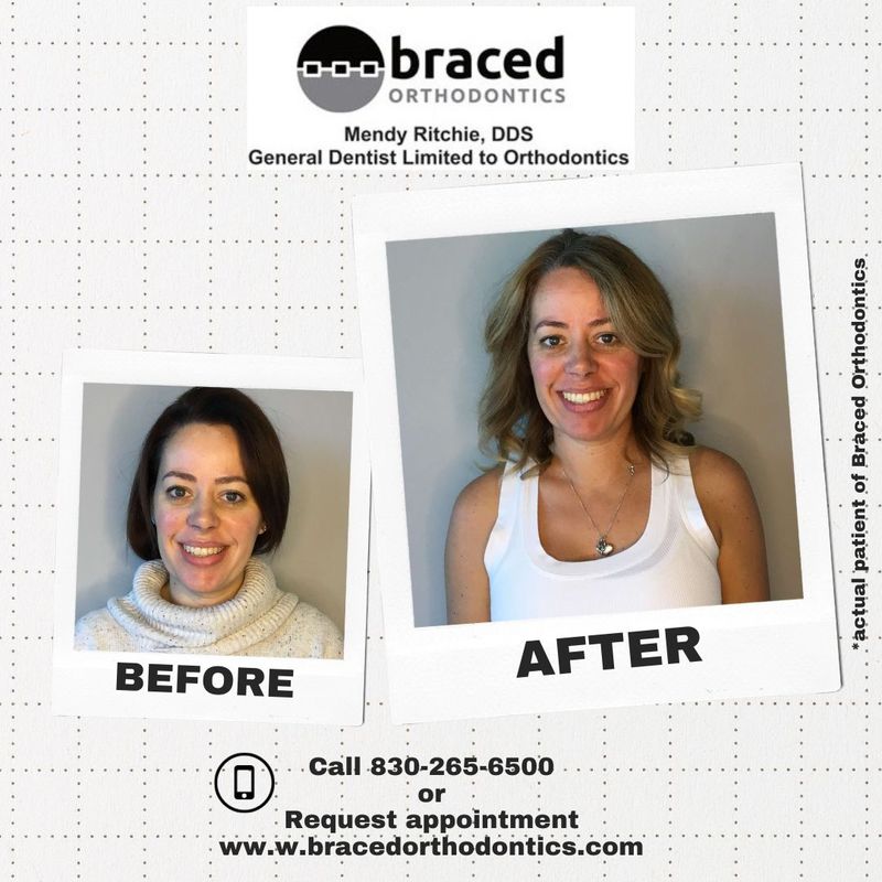 before and after braces in Marble Falls, TX