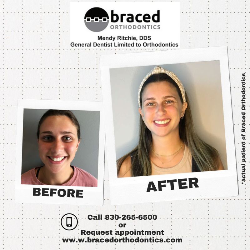 before and after braces in Marble Falls, TX